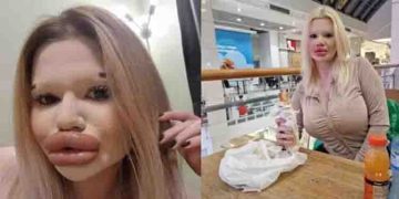 യഥാർത്ഥ പ്രണയത്തിന് വേണ്ടി കാത്തിരിക്കുകയാണ്; ലോകത്തിലെ ഏറ്റവും വലിയ ചുണ്ടുള്ള യുവതി പറയുന്നു