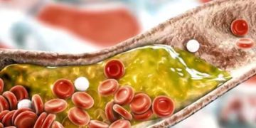 ചീത്ത കൊളസ്ട്രോൾ കുറയ്ക്കാൻ സഹായിക്കുന്ന ആറ് സൂപ്പർ ഫുഡുകളിതാ…