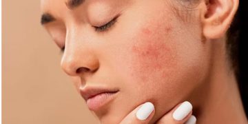 മുഖക്കുരുവിന്‍റെ പാടുകൾ അകറ്റാന്‍ പരീക്ഷിക്കാം ഈ ഏഴ് പാക്കുകള്‍…