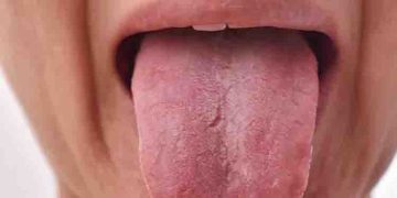 നാവില്‍ തടിപ്പും പുണ്ണും ഒപ്പം ദഹനപ്രശ്നങ്ങളും; കാരണം ഇതാകാം…