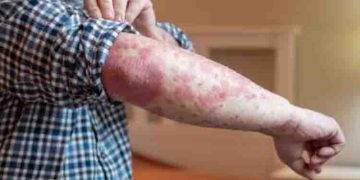 സോറിയാസിസ് രോഗം നേരത്തെ തിരിച്ചറിയാം ; ശ്രദ്ധിക്കേണ്ടത്…