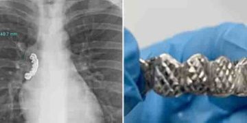 കടുത്ത ചുമയും ശ്വാസംമുട്ടലും; 22കാരന്‍റെ ശ്വാസകോശത്തിൽ കുടുങ്ങിയത്…