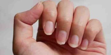 നഖത്തിനും മുടിക്കും പറ്റുന്ന കേടുപാടുകള്‍ ഈ പ്രശ്നത്തിന്‍റെ സൂചനയാകാം…