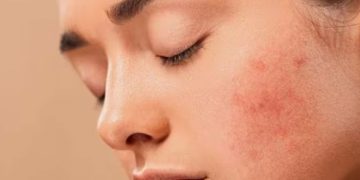 മുഖക്കുരുവിന്‍റെ പാടുകൾ അകറ്റാന്‍ പരീക്ഷിക്കാം ഈ ഏഴ് പാക്കുകള്‍…