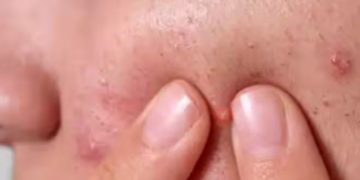 മുഖക്കുരുവിനുള്ള സാധ്യതയെ കൂട്ടും ഈ ഭക്ഷണങ്ങള്‍…