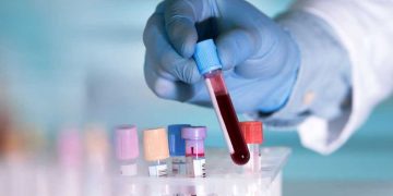 തലച്ചോറിലെ അര്‍ബുദ മുഴ തിരിച്ചറിയാന്‍ രക്ത പരിശോധന വികസിപ്പിച്ചു