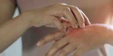 ചർമ്മത്തിൽ ഈ ലക്ഷണങ്ങൾ‌ കണ്ടാൽ നിസാരമായി കാണരുത്, അറിയാം ഈ രോ​ഗത്തെ…