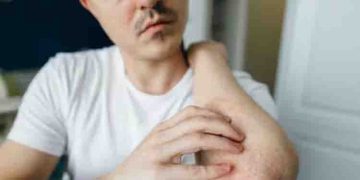 എക്സീമയുടെ ഈ ലക്ഷണങ്ങളെ അറിയാതെ പോകരുത്…