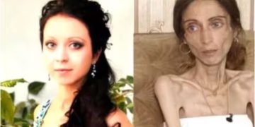 ‘ചീര്‍ത്ത കവിളെ’ന്ന് പരിഹാസം; 22 കിലോ കുറച്ച യുവതി ആശുപത്രിയില്‍, പിന്നാലെ ഭര്‍ത്താവും ഉപേക്ഷിച്ചു!