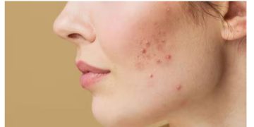 മുഖക്കുരുവിനും സ്കിൻ രോഗങ്ങള്‍ക്കും അലര്‍ജികള്‍ക്കുമെല്ലാം ഇത് കാരണമാകാം…