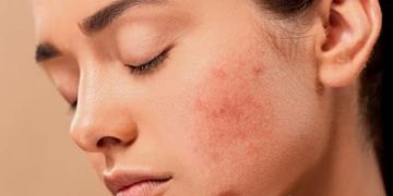 മുഖക്കുരുവിന്റെ പാടുകൾ അകറ്റാൻ‌ ഇതാ മൂന്ന് വഴികൾ