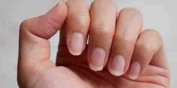നഖം പൊട്ടുന്നത് പതിവാണോ? എങ്കില്‍ നിങ്ങള്‍ ഭക്ഷണത്തില്‍ ശ്രദ്ധിക്കേണ്ടത്…