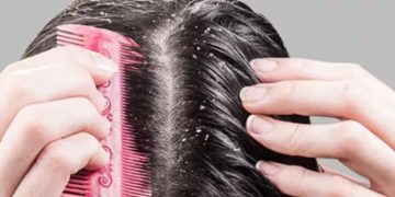 താരനകറ്റാൻ നാരങ്ങ ഉപയോ​ഗിക്കാറുണ്ടോ? എങ്കിൽ‌ ഒന്ന് ശ്രദ്ധിക്കൂ