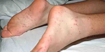 കേരളത്തില്‍ എലിപ്പനിയും ഡെങ്കിപ്പനിയും; തിരിച്ചറിയൂ ഈ ലക്ഷണങ്ങളിലൂടെ