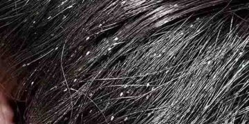 പേൻ ശല്യം നിങ്ങളെ അലട്ടുന്നുണ്ടോ? പരിഹാരം വീട്ടിൽ തന്നെയുണ്ട്