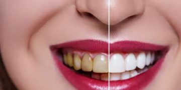 പല്ലുകളിലെ കറ മാറാന്‍ പരീക്ഷിക്കാം ഈ 12 വഴികള്‍…