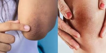 ശരീരത്തിലെ ഇരുണ്ട പാടുകള്‍ അകറ്റാന്‍ വീട്ടില്‍ പരീക്ഷിക്കാം ഈ വഴികള്‍…