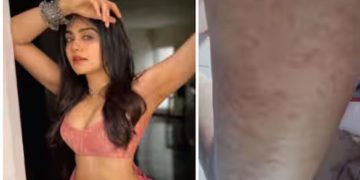 ബാധിച്ച രോഗത്തിന്‍റെ ചിത്രങ്ങള്‍ പങ്കുവച്ചു; പിന്നാലെ കേരള സ്റ്റോറി നായിക ആദാ ശർമ്മ ആശുപത്രിയില്‍ അഡ്മിറ്റായി