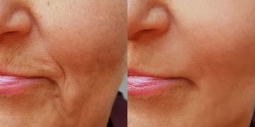 മുഖത്തെ ചുളിവുകള്‍ മാറാന്‍ പരീക്ഷിക്കാം ഈ കിടിലന്‍ ഫേസ് പാക്കുകള്‍…