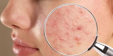 മുഖക്കുരു നിങ്ങളെ അലട്ടുന്നുണ്ടോ? എ​ങ്കിൽ പരീക്ഷിക്കാം ഈ ഫേസ് പാക്ക്