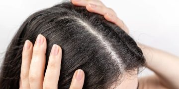 താരന്‍ അകറ്റാന്‍ അടുക്കളയിലുണ്ട് അഞ്ച് മാര്‍ഗങ്ങള്‍