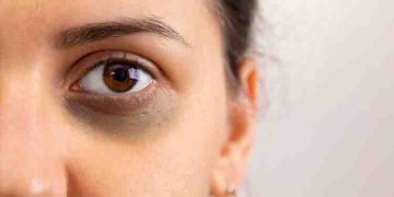 കണ്ണിന് ചുറ്റുമുള്ള കറുപ്പ് മാറാൻ ഇതാ ചില പൊടിക്കെെകൾ