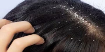 താരനെ അകറ്റാന്‍ അടുക്കളയിലുണ്ട് വഴികള്‍…