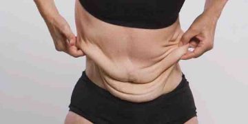 വണ്ണം കുറച്ചതിന് ശേഷമുള്ള അയഞ്ഞു തൂങ്ങിയ ചർമ്മം ഒഴിവാക്കാന്‍ ചെയ്യേണ്ട ഒമ്പത് കാര്യങ്ങള്‍…