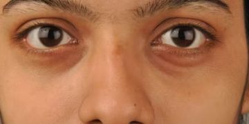 കൺതടങ്ങളിലെ ഇരുണ്ട നിറം; അറിയാം കാരണങ്ങളും പൊടിക്കൈകളും…