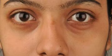 കൺതടങ്ങളിലെ ഇരുണ്ട നിറം; അറിയാം കാരണങ്ങളും പൊടിക്കൈകളും…