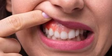 വായിലെ ക്യാന്‍സര്‍; തുടക്കത്തിലെ കാണിക്കുന്ന ഈ പത്ത് ലക്ഷണങ്ങളെ അവഗണിക്കരുത്…