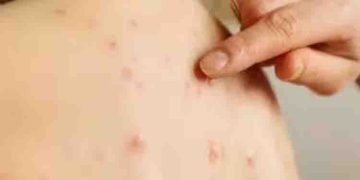 അഞ്ചാംപനി ; ലക്ഷണങ്ങൾ അറിയാം