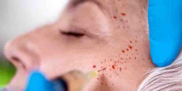 വാംപയർ ഫേഷ്യലിലൂടെ എച്ച്.ഐ.വി പടർന്നു, ഉറവിടം അജ്ഞാതം; ബ്യൂട്ടി സ്പായുടെ പ്രവർത്തനത്തിൽ അന്വേഷണം