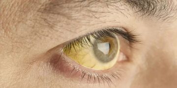 മലപ്പുറത്ത് ജൂണിൽ മാത്രം 1761 മഞ്ഞപ്പിത്തക്കേസുകൾ