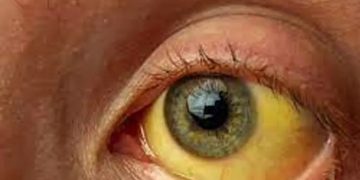 മലപ്പുറം വള്ളിക്കുന്നില്‍ മഞ്ഞപ്പിത്തം പടരുന്നു; ജാഗ്രത നിര്‍ദേശം