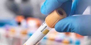 കോഴിക്കോട് ‌സ്കൂളിൽ മഞ്ഞപ്പിത്ത ബാധ; 50 ഓളം വിദ്യാർത്ഥികൾക്ക് രോഗം സ്ഥിരീകരിച്ചു, പ്രതിരോധ പ്രവർത്തനം തുടങ്ങി