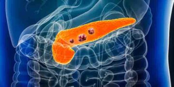 പാൻക്രിയാറ്റിക് ക്യാൻസർ; ഈ പ്രാരംഭ ലക്ഷണങ്ങളെ നിസാരമായി കാണരുത്