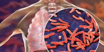 ക്ഷയരോഗികളുടെ എണ്ണം വർദ്ധിക്കുന്നു ; രോഗികളില്‍ 26 ശതമാനവും ഇന്ത്യയില്‍