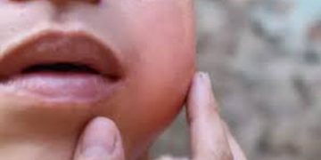 സംസ്ഥാനത്ത് കുട്ടികൾക്കിടയിൽ മുണ്ടിനീര് ബാധിതരുടെ എണ്ണം കുതിച്ചുയരുന്നതായി ആരോഗ്യ വകുപ്പ്