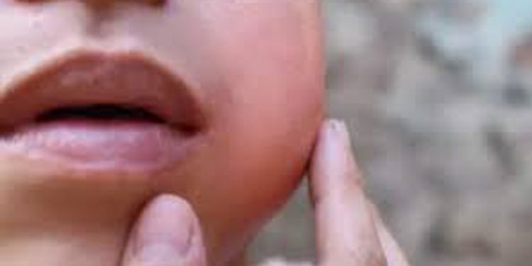 സംസ്ഥാനത്ത് കുട്ടികൾക്കിടയിൽ മുണ്ടിനീര് ബാധിതരുടെ എണ്ണം കുതിച്ചുയരുന്നതായി ആരോഗ്യ വകുപ്പ്