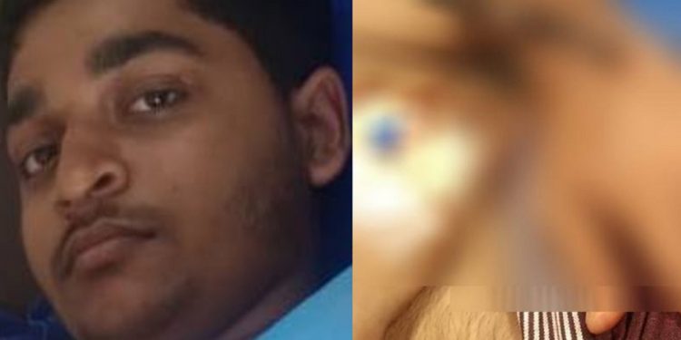 കൂത്തുപറമ്പ് കണ്ടേരിയിൽ മുള്ളൻ പന്നിയുടെ ആക്രമണത്തിൽ പ്ലസ് വൺ വിദ്യാർത്ഥിക്ക് പരിക്ക്